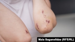 დაზიანებები დაზარალებული ქალის ხელებზე
