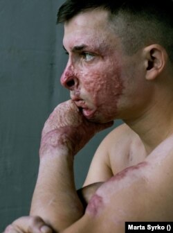 Illiya, fotografiat de Marta Syrko. Bărbatul a fost cuprins de flăcări în tancul său, în timpul unei misiuni. Este îngrijorat din pricina aspectului său fizic, pentru că lumea se holbează sau se tem de el.