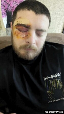 აქციაზე დაზარალებული 24 წლის ნიკა დემურიშვილი