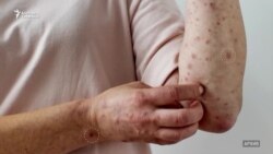 Кыргызстанда кызылча илдети жайылууда