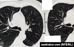 Рентгеновский снимок легких пациента с COVID-19