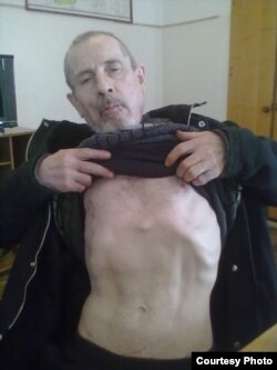 Николай Валетов показывает следы от пыток.