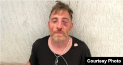 Lekso Lashkarava after being beaten.