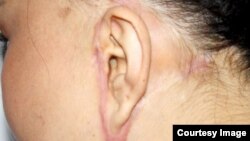 Кыргызстанка, за ушами которой остались огромные шрамы после пластической операции