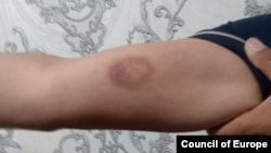 Сирожиддин Қурбоновга ИИБ ходимлари етказган жароҳат