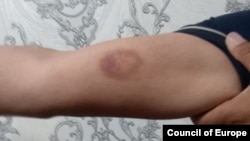 Сирожиддин Құрбанов милиция қызметкерлері қол жұмсап, көгертіп тастаған қолын көрсетіп тұр